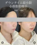 顔の脂肪吸引 7日後 サムネイル用