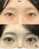 二重埋没 before画像 サムネイル用