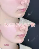 アゴのヒアルロン酸 before画像 サムネイル用