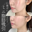 【ミニ脂肪吸引】口横ぽにょ消えた！ after画像 サムネイル用