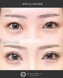 【20代女性・平行型二重】二重埋没・目頭切開 before画像 サムネイル用