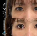 くま取り＋脂肪注入 after画像 サムネイル用