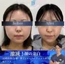 3D脂肪吸引（頬・顎下）/メーラーファット除去 /糸リフト before画像 サムネイル用
