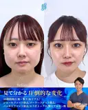 3D脂肪吸引(頬・顎下)/バッカルファット除去/メーラーファット除去/ジョールファット除去/糸リフト/エラボト before画像 サムネイル用