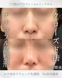 鼻尖形成耳介軟骨移植（クローズ法） before画像 サムネイル用