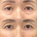 目の下のふくらみ取り・脂肪注入 before画像 サムネイル用