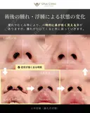 人中短縮（鼻孔内切開） 90日後 サムネイル用