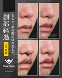 人中短縮（鼻孔内切開） before画像 サムネイル用