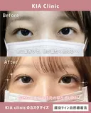 すっぴんも盛れる♡理想の二重ライン before画像 サムネイル用