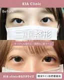 すっぴんも盛れる♡理想の二重ライン after画像 サムネイル用