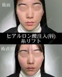 ヒアルロン酸注入（唇）/糸リフト 0日後 サムネイル用