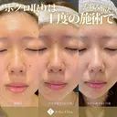 顔・身体OK！当院人気No１ホクロ治療✨年間10万個ホクロ・イボ除去Dr在籍🐰 after画像 サムネイル用