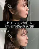 ヒアルロン酸注入（頬/唇/涙袋/貴族/顎） before画像 サムネイル用