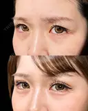 山本の二重埋没 before画像 サムネイル用