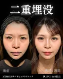 山本の二重埋没 after画像 サムネイル用