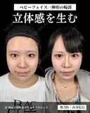 山本による🎀小顔脂肪吸引🎀 after画像 サムネイル用