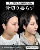山本による🎀小顔脂肪吸引🎀 after画像 サムネイル用