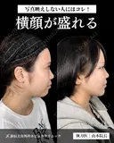 山本による🎀小顔脂肪吸引🎀 after画像 サムネイル用