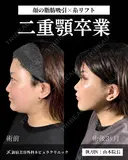 山本による🎀小顔脂肪吸引🎀 after画像 サムネイル用