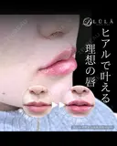 スマイルリップ（ボリフト） after画像 サムネイル用