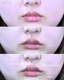 スマイルリップ after画像 サムネイル用