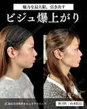 山本による🎀小顔脂肪吸引🎀 after画像 サムネイル用