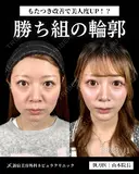 山本による🎀小顔脂肪吸引🎀 after画像 サムネイル用