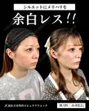 山本による🎀小顔脂肪吸引🎀 before画像 サムネイル用