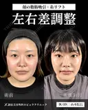 山本による🎀小顔脂肪吸引🎀 after画像 サムネイル用