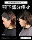 山本による🎀小顔脂肪吸引🎀 before画像 サムネイル用