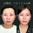 Wing小顔女神脂肪吸引 before画像 サムネイル用