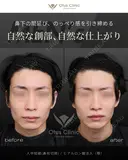 鼻柱切開人中短縮・ヒアルロン酸注入（顎） before画像 サムネイル用