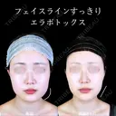 エラボトックス 90日後 サムネイル用