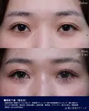 眼瞼下垂埋没法 after画像 サムネイル用