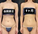 シークレット脂肪吸引自院修正 before画像 サムネイル用