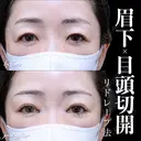 目頭切開(リドレープ法)･眉下切開 0日後 サムネイル用