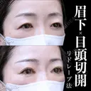 目頭切開(リドレープ法)･眉下切開 0日後 サムネイル用