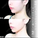 頬・あご下脂肪吸引 /糸リフト/ジョールファット/エラボトックス before画像 サムネイル用