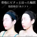頬・あご下脂肪吸引 /糸リフト/ジョールファット/エラボトックス 180日後 サムネイル用