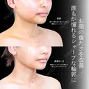 頬・顎下脂肪吸引/ジョールファット/糸リフト before画像 サムネイル用