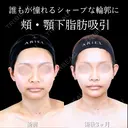 頬・顎下脂肪吸引/ジョールファット/糸リフト 90日後 サムネイル用