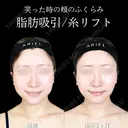 頬・顎下脂肪吸引/糸リフト/バッカルファット/ジョールファット/エラボトックス 90日後 サムネイル用
