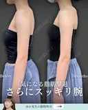 脂肪吸引(二の腕) before画像 サムネイル用