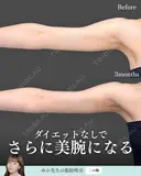 脂肪吸引(二の腕) 180日後 サムネイル用