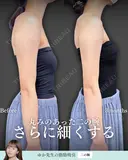 脂肪吸引(二の腕) before画像 サムネイル用