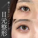 【目元整形】優しい目元にアップデート after画像 サムネイル用