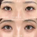 【目元整形】優しい目元にアップデート before画像 サムネイル用