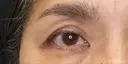 【50代女性・切らずに目の開き改善】眼瞼下垂埋没法（1ヶ月後） before画像 サムネイル用