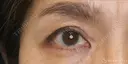 【50代女性・切らずに目の開き改善】眼瞼下垂埋没法（1ヶ月後） 30日後 サムネイル用