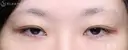 【30代女性・目力を改善】眼瞼下垂手術＋目頭切開（4ヶ月後） before画像 サムネイル用
